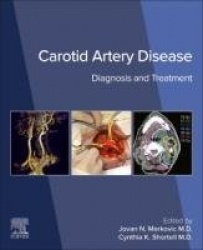 Carotid Artery Disease - Diagnosis and Treatment